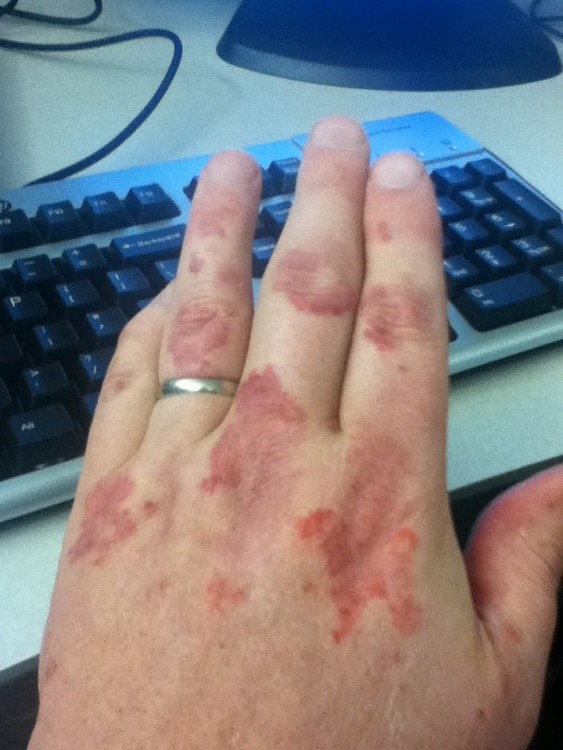 hand over keyboard that shows lupus flare, rash and swelling