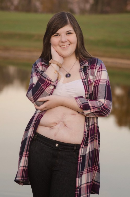 young woman standing in front of a lake and wearing an open flannel jacket with visible scars on her stomach
