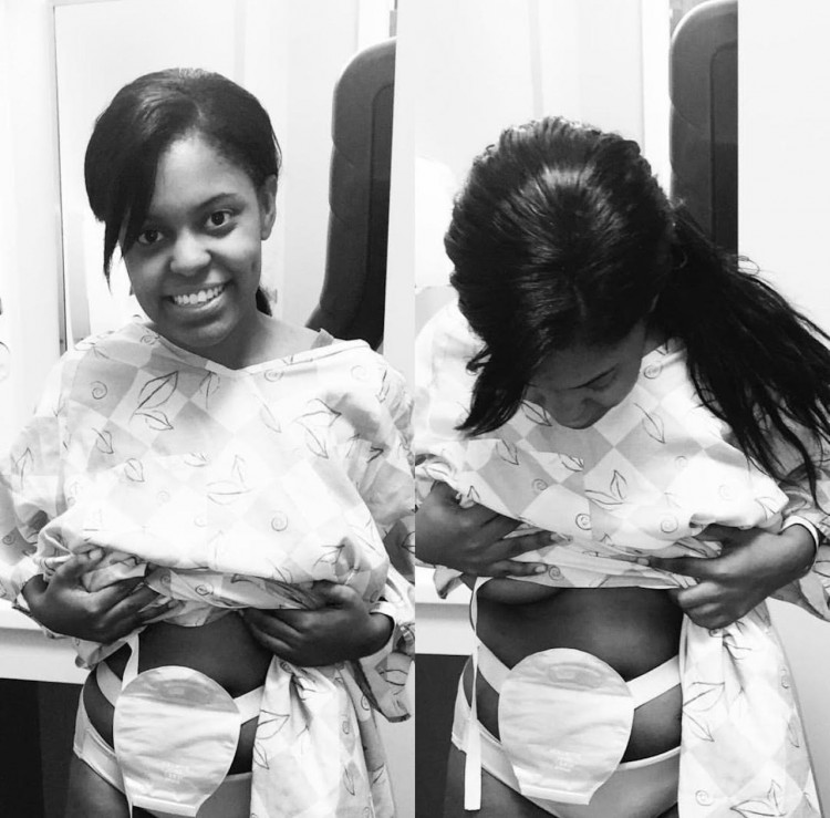 woman standing up in a hospital gown and revealing her ostomy