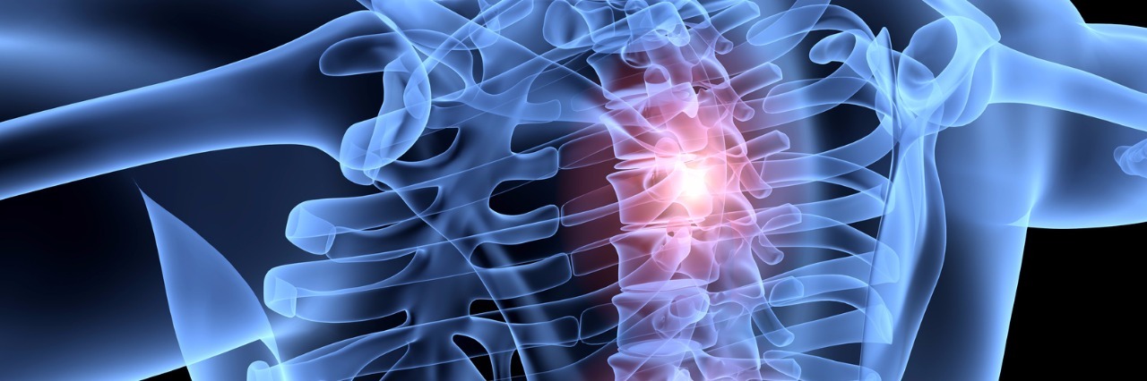 Things Nobody Told Me About Scoliosis After My Diagnosis x-ray view of spine with three areas on the spine highlighted