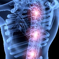x-ray view of spine with three areas on the spine highlighted