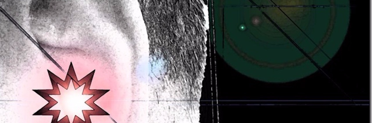 Using Manipulated Photography to Teach About Meniere's Disease manipulated photograph of an ear to show what meniere's disease feels like