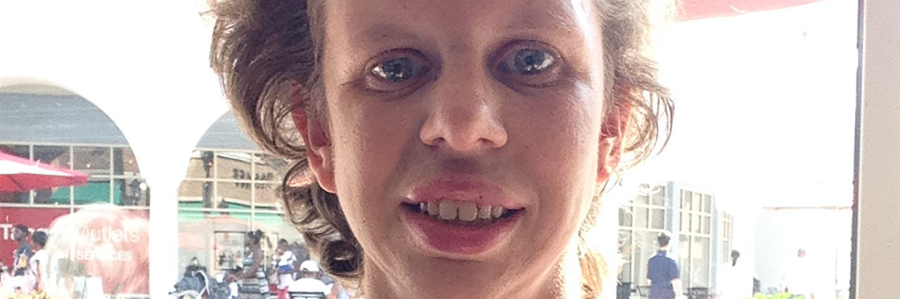 Living With Williams Syndrome Michelle Baymiller.