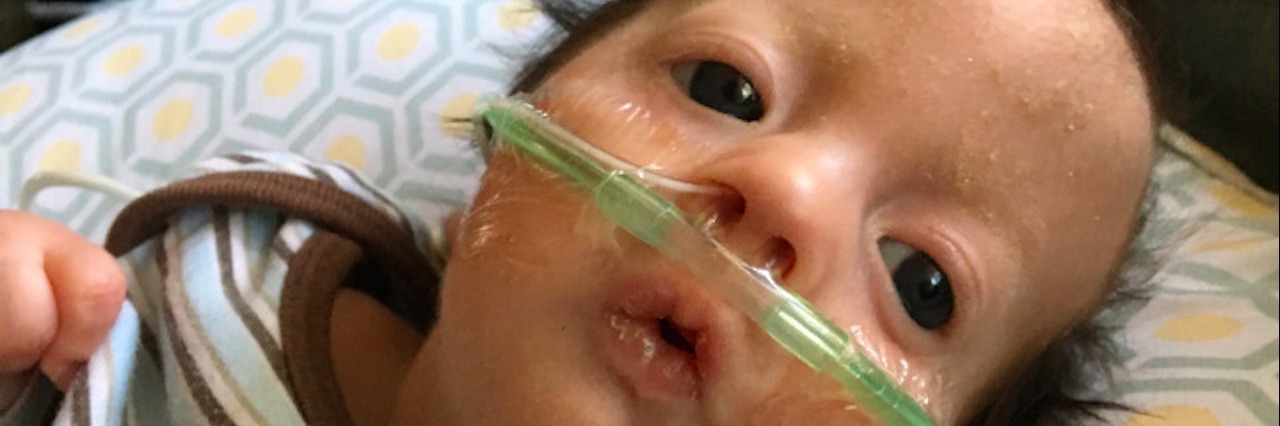 Seeing Friends Have Babies as a Parent to a Terminally Ill Child baby boy wearing oxygen tube and striped shirt