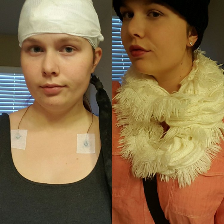 photo of girl wearing bandage on head and photo of her wearing a hat and scarf