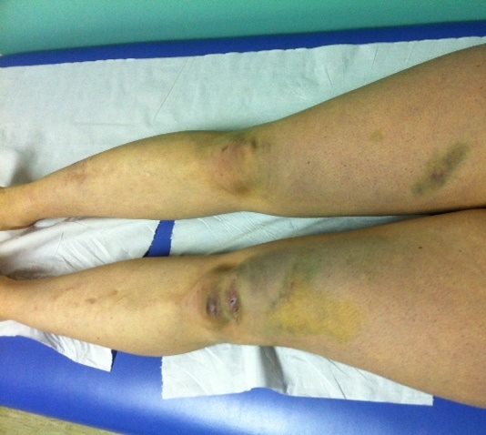 woman's legs with bruises on knees and thigh