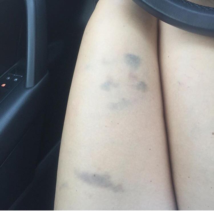 Lots Of Small Bruises On Legs