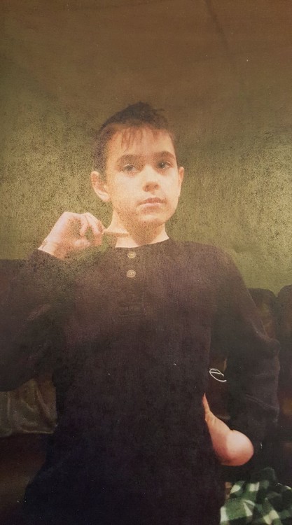 boy demonstrating stretchy skin and bending back his wrist