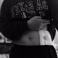 black and white photo of girl with feeding tube on stomach