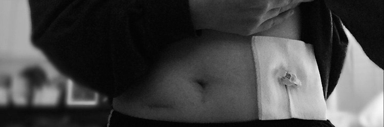 What Nobody Tells You About Having a Feeding Tube girl lifting up sweatshirt to show feeding tube on stomach
