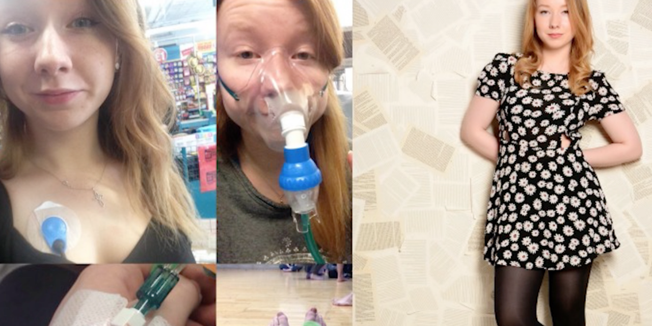 These Pictures Show What Ehlers Danlos Syndrome Really Looks 3717