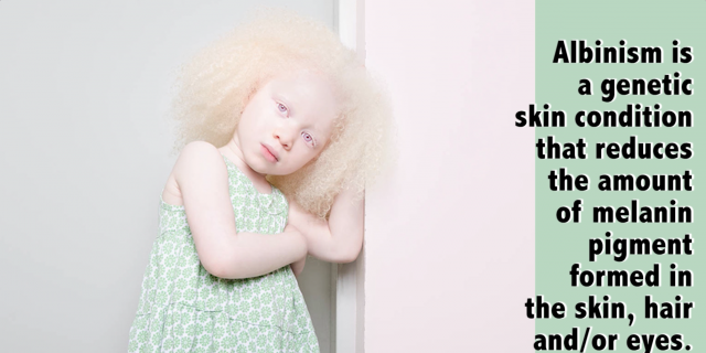 girl with albinism