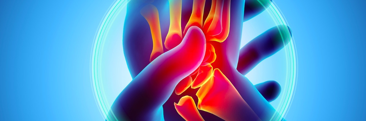 What Living With Carpal Tunnel Syndrome Is Like for Me Illustration of carpal tunnel syndrome, someone holding a painful wrist