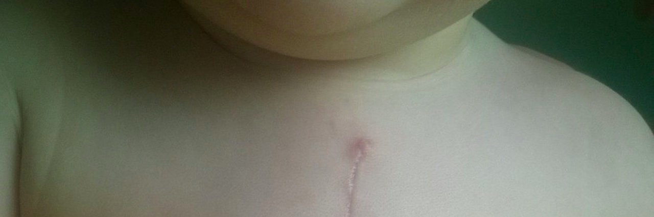 Mother of Son With Congenital Heart Defect Gets Asked If He’s ‘Fixed’ boy with scars after heart surgery