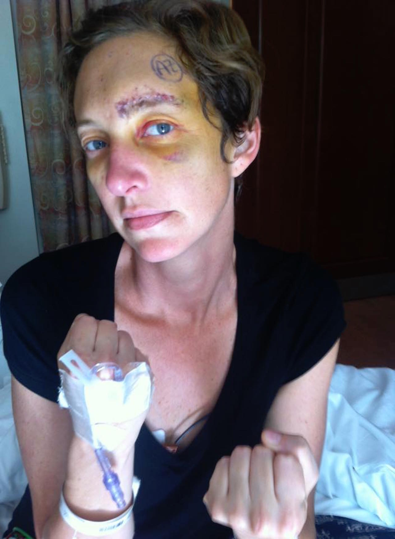 woman post-op craniotamy