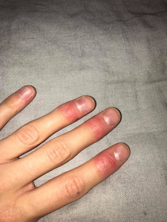 red and sore fingers 