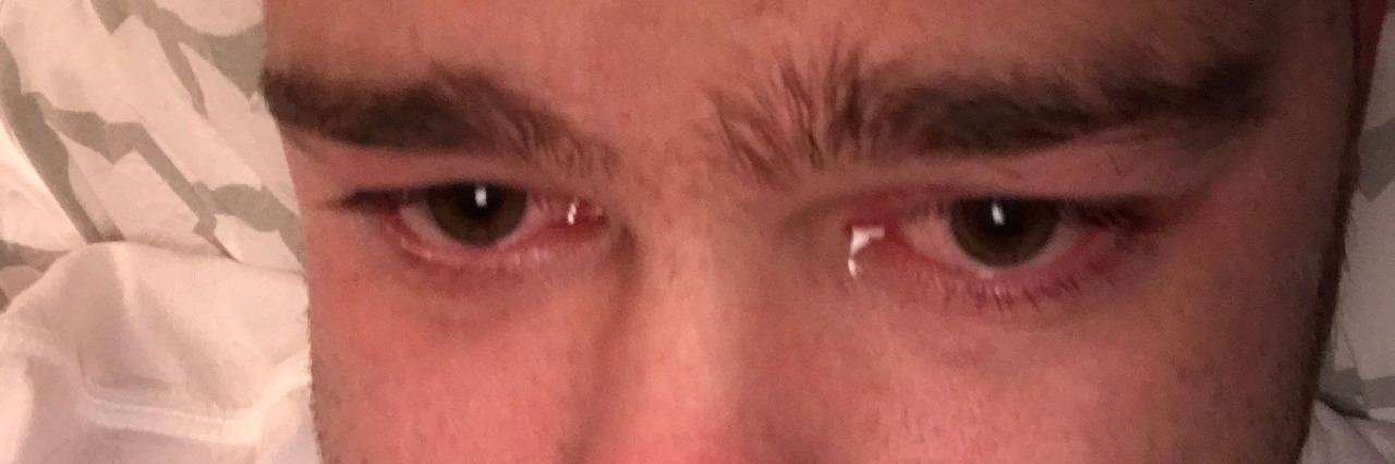 Why I Have Survivor's Guilt as a Man With Congenital Heart Disease selfie of man's face lying in bed