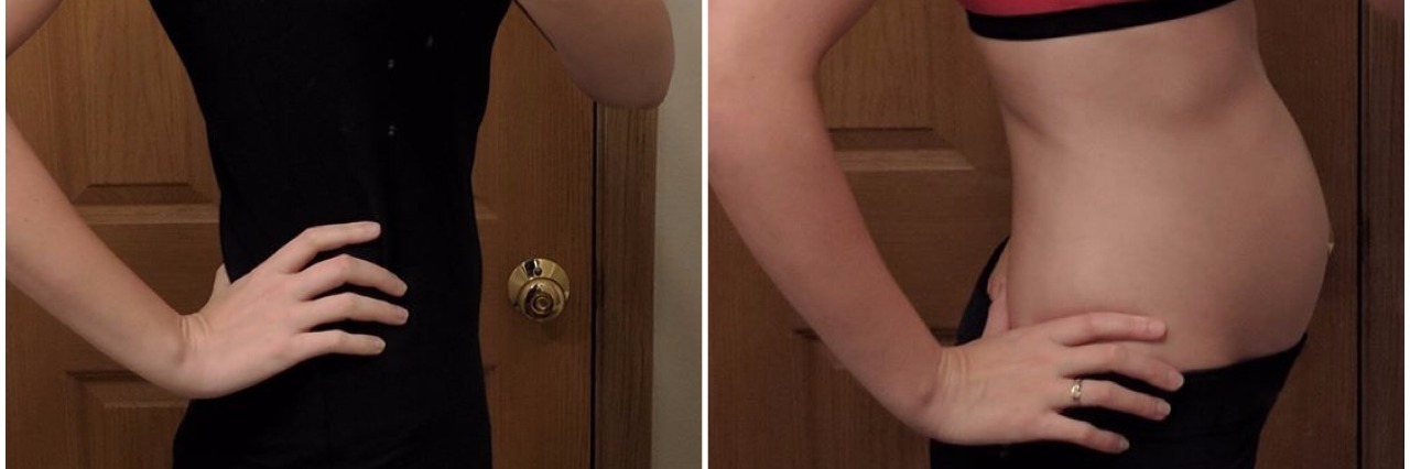 Endometriosis Belly: Wearing Maternity Clothes for Stomach Swelling photo of woman before and after having endometriosis belly