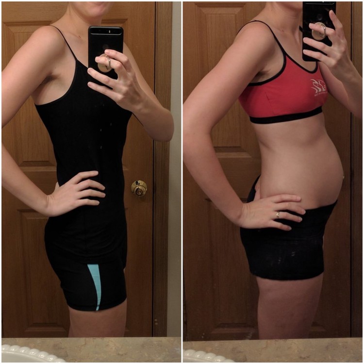 photo of woman before and after having endometriosis belly