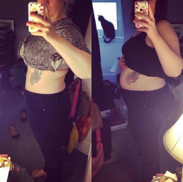 photo of woman before and after stomach swelling from endometriosis