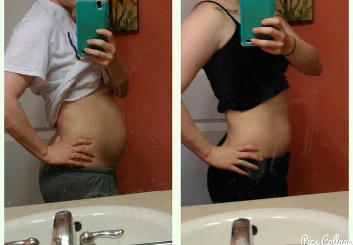 photo of woman with swollen stomach because of endometriosis