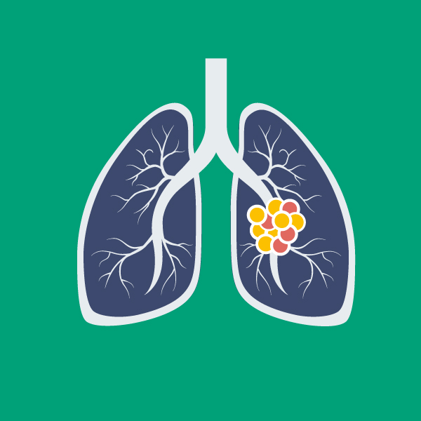 Lung Cancer | Signs, Symptoms, Support