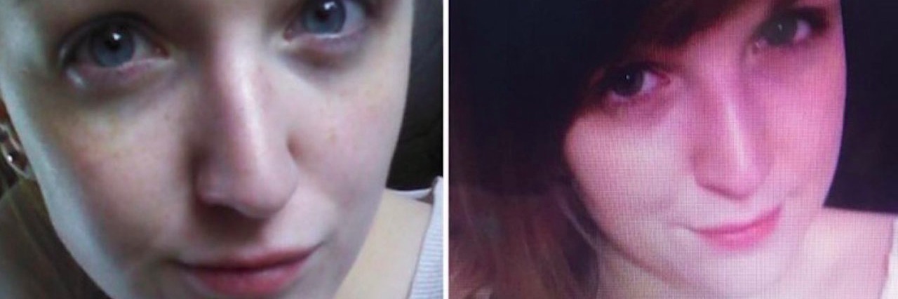 The Different Sides of Hypothyroidism photos of woman show different sides of hypothyroidism