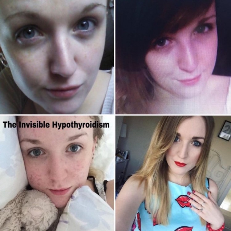 photos of woman show different sides of hypothyroidism