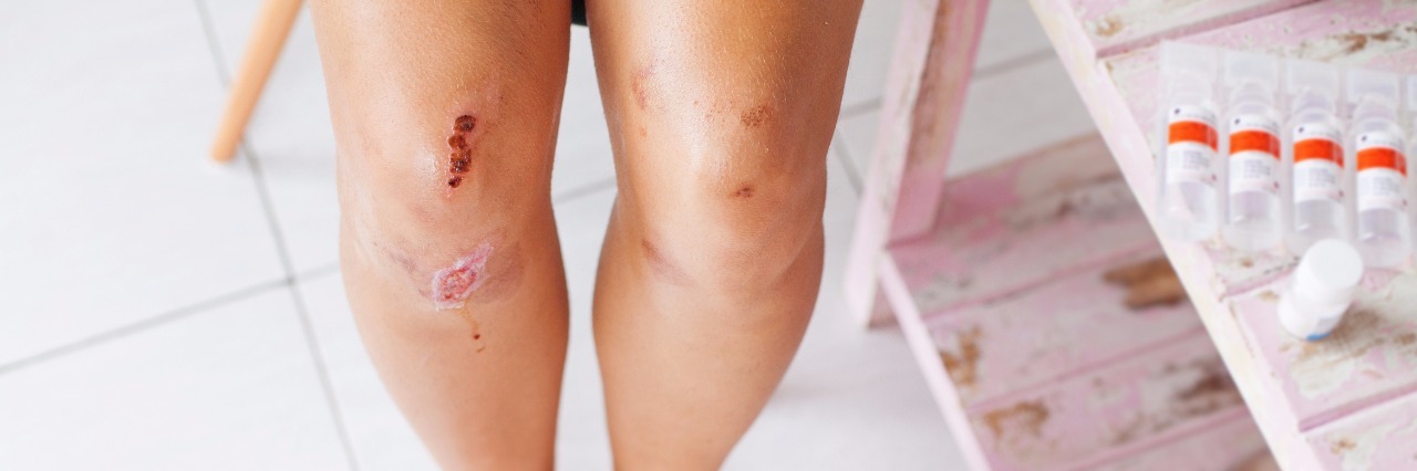 Woman with scraped knees.