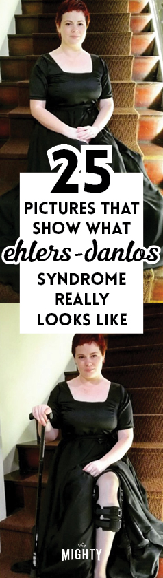  25 Pictures That Show What Ehlers-Danlos Syndrome Really Looks Like 