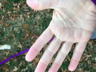 woman's hand after a mild attack of raynaud's
