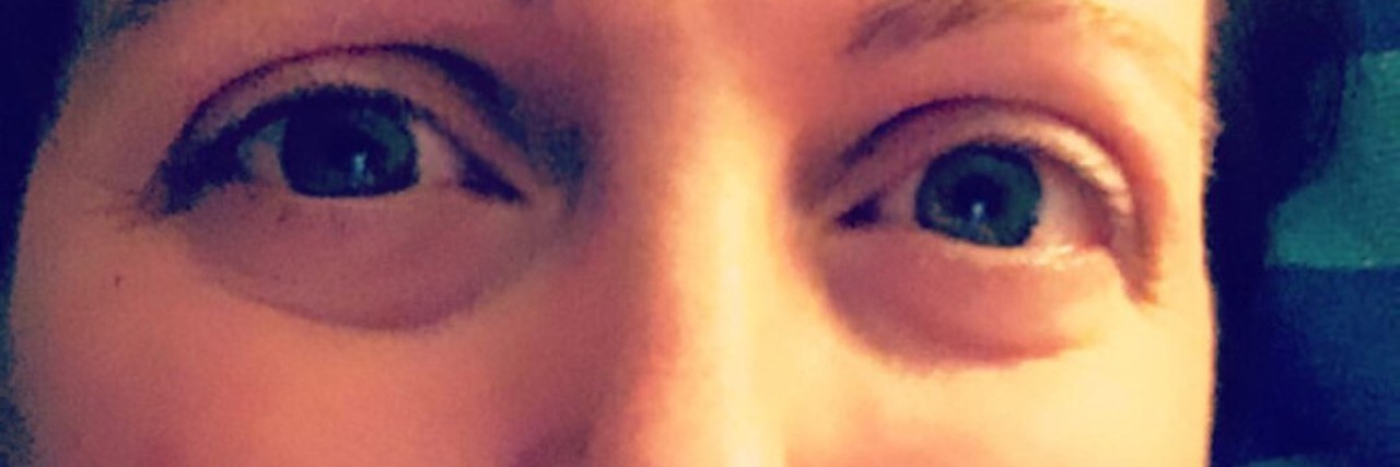 Having Control Over Life as a Parent With Dysautonomia woman's eyes