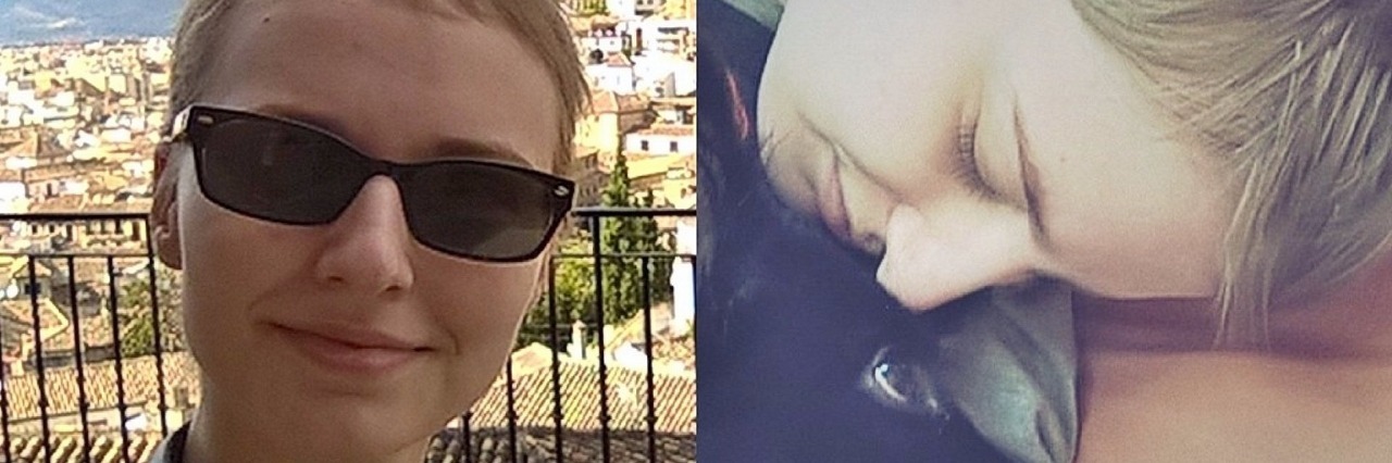 A Letter to Katy Perry, From Someone With Trichotillomania Two pictures of the contributor with short hair.