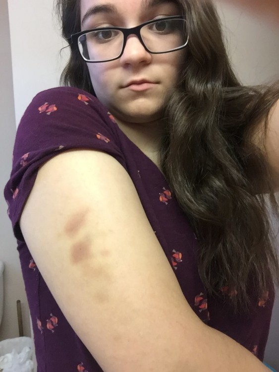 woman showing bruises on her arm