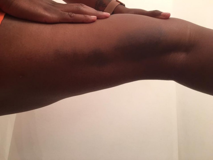 woman's leg with bruises