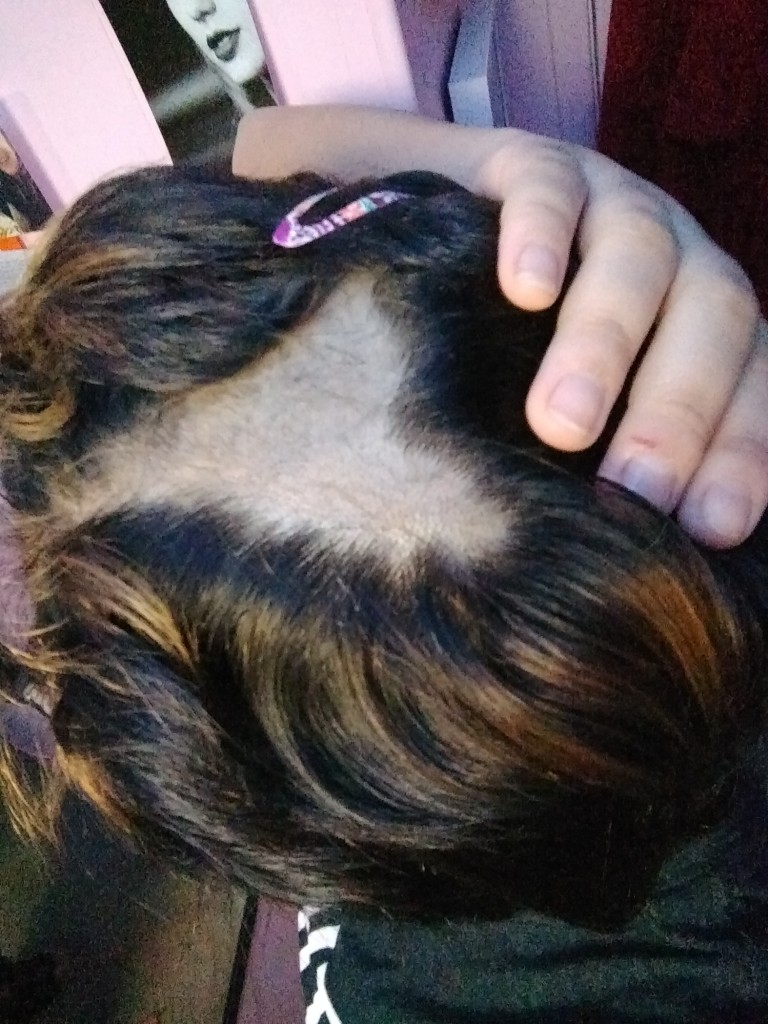 woman with bald spot parting hair trichotillomania