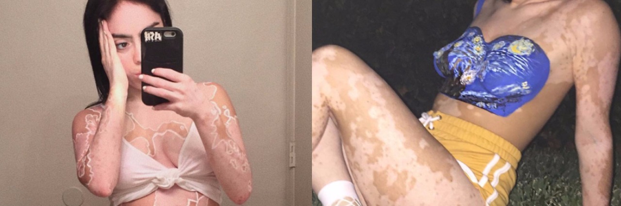 Ashley Soto Turns Vitiligo Into Works of Art Ashley Soto with a map of the world painted on her chest.