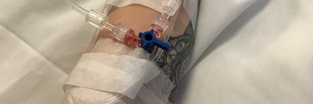 Being Positive With Uveitis, Vasculitis, Chronic Illness woman's arm with IV and bandages