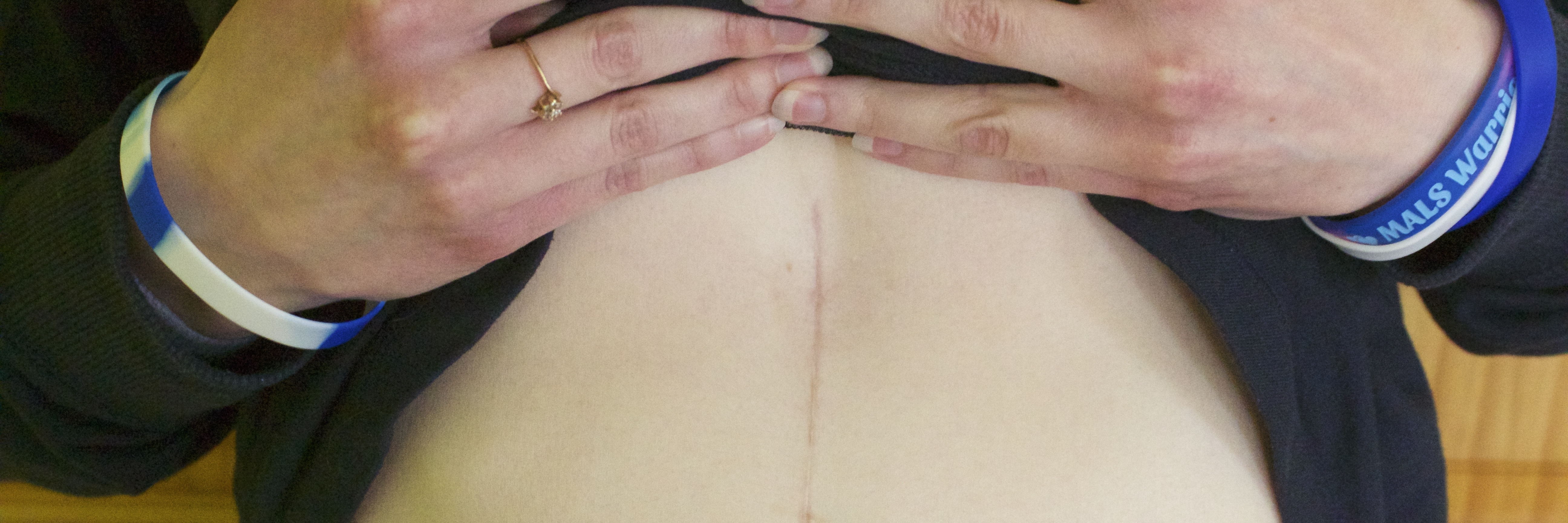 woman holding up shirt to show scar on stomach