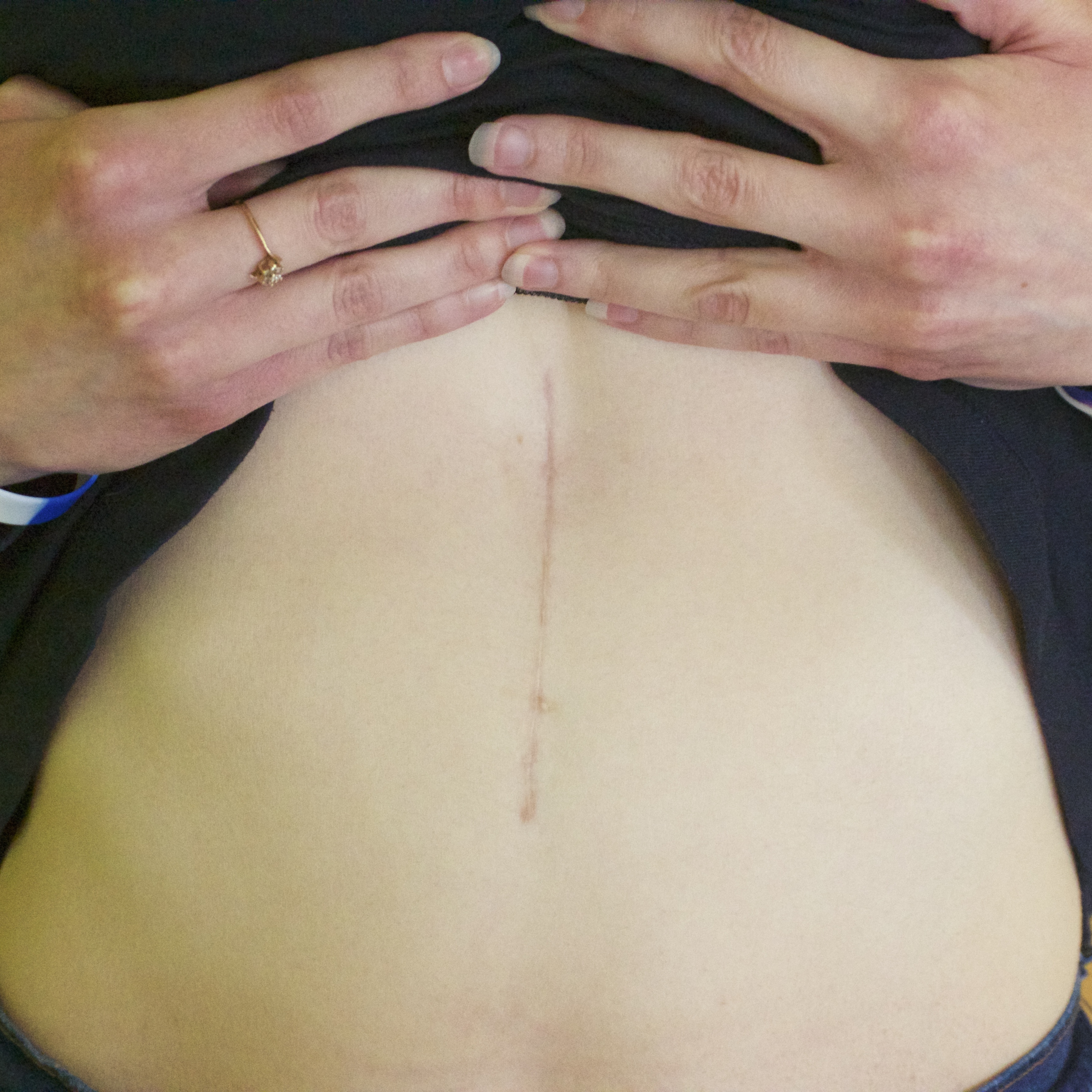 woman holding up shirt to show scar on stomach