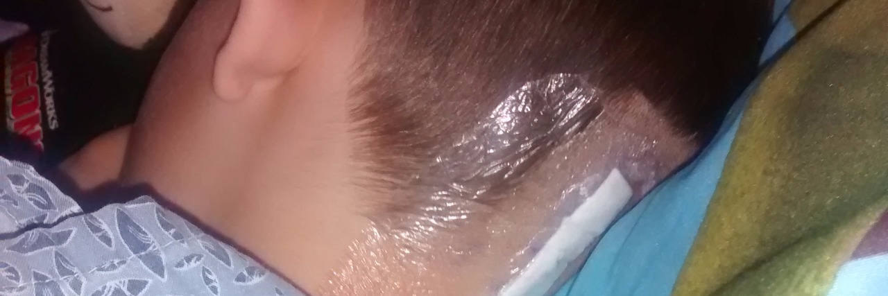 Chiari Malformation and Looking at My Son's 'Salt Spot' on His Neck little boy with scar