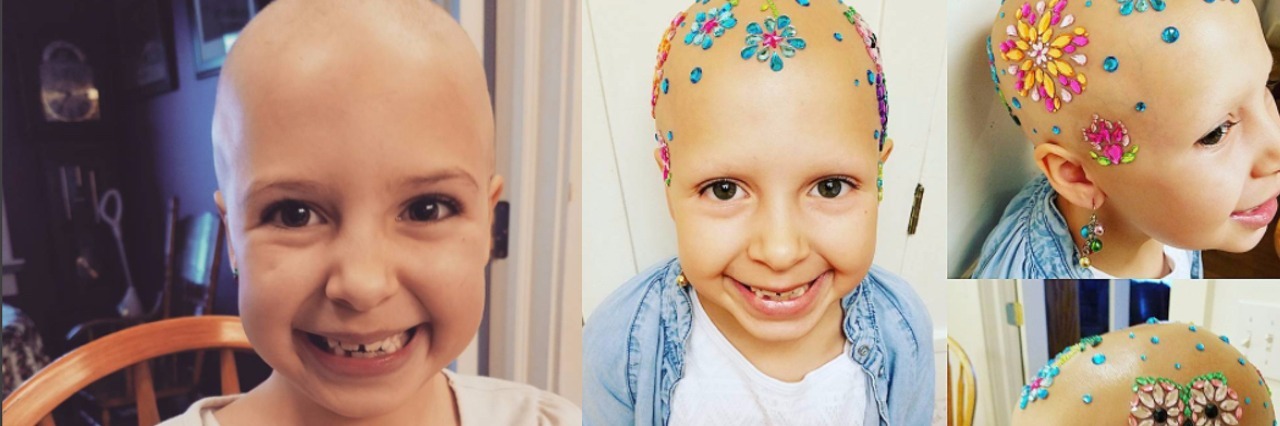 Gianessa Wride Celebrates 'Crazy Hair Day' With Alopecia bald young girl with jewel stickers on her head.