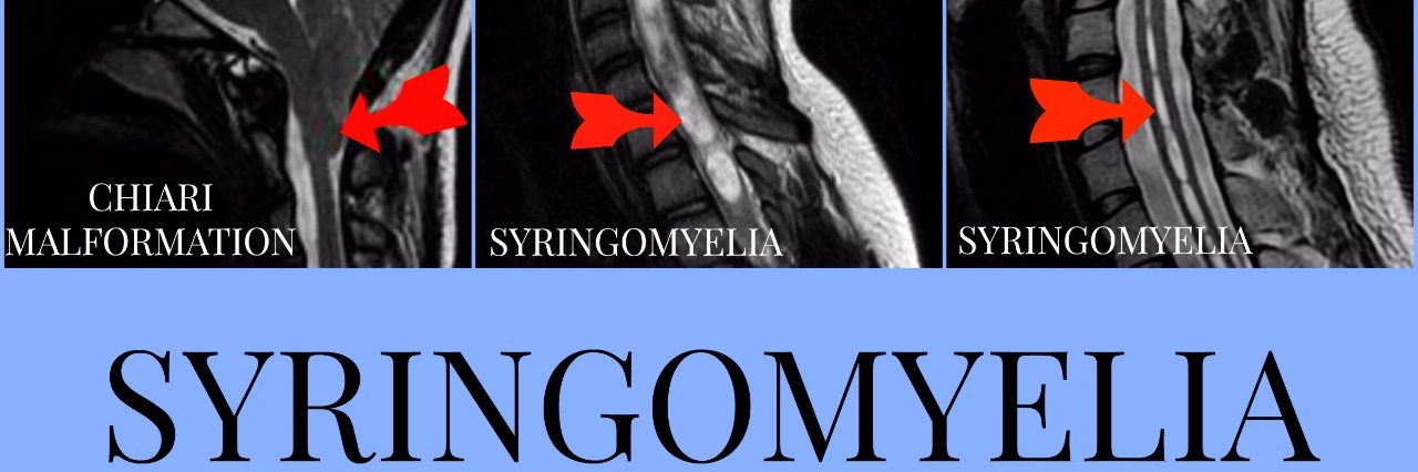 15 Things People With Syringomyelia Want You to Know photo of x rays with syringomyelia