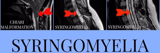 photo of x rays with syringomyelia
