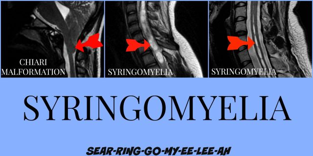 photo of x rays with syringomyelia