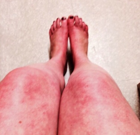 lacy cobweb rash called livedo