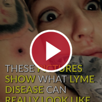 These Pictures Show What Lyme Disease Can Really Look Like