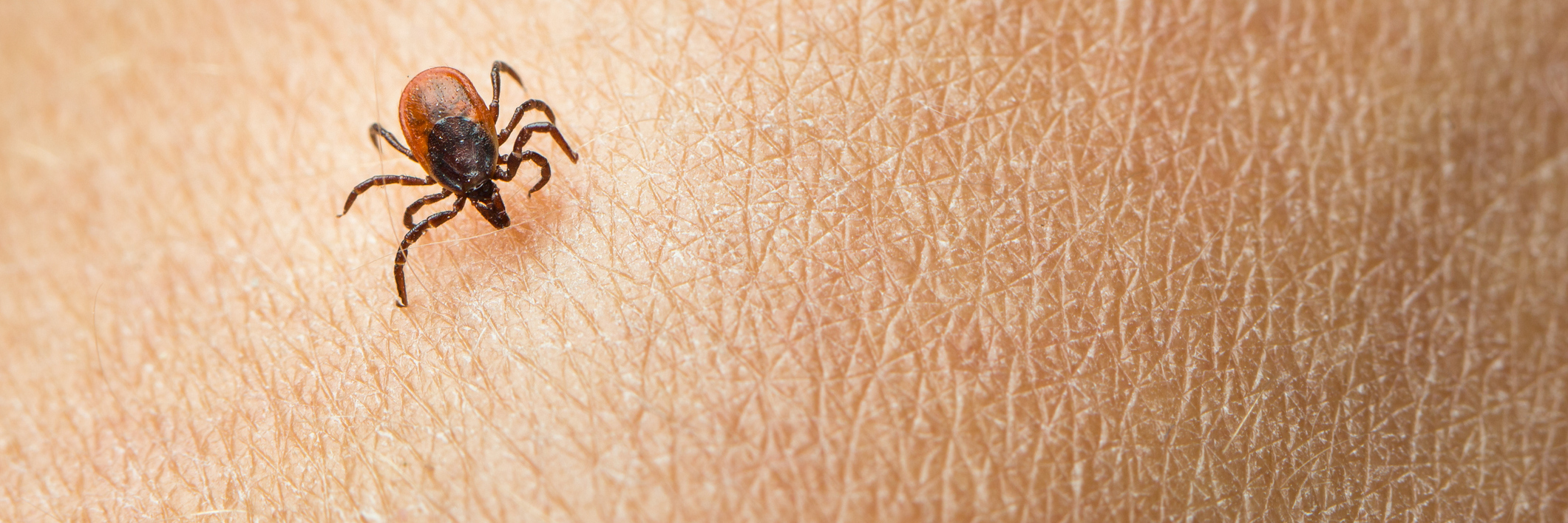 Sharing Stories to Raise Awareness of Lyme Disease tick crawling on a person's skin