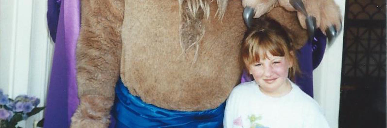 Watching 'Beauty and the Beast' With a Port-Wine Stain Birthmark