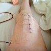 seven-inch scar down a woman's knee